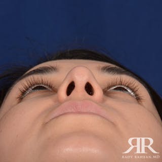 Female Rhinoplasty Before & After Gallery - Patient 140417 - Image 8