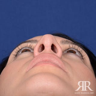Rhinoplasty w/ Chin Implant Before & After Gallery - Patient 354776 - Image 8