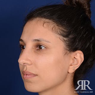 Ethnic Rhinoplasty Before & After Gallery - Patient 224907 - Image 4