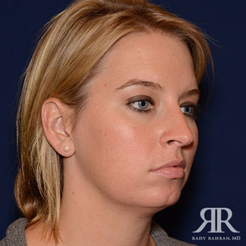 Chin Augmentation Before & After Gallery - Patient 310780 - Image 3