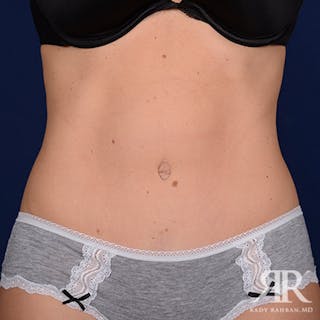 Tummy Tuck Before & After Gallery - Patient 125258 - Image 2