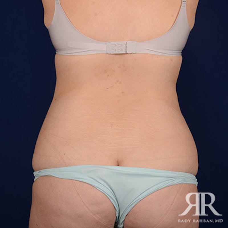 Body Lift Before & After Gallery - Patient 370415 - Image 7