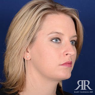 Chin Augmentation Before & After Gallery - Patient 310780 - Image 4