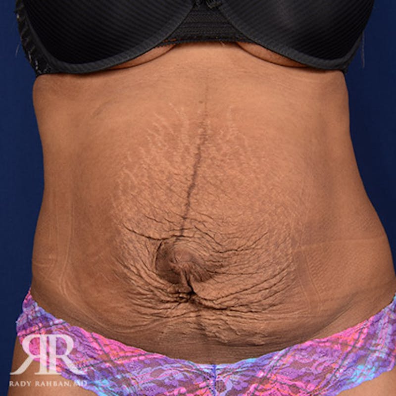 Severe Diastasis Recti Before & After Gallery - Patient 348497 - Image 1