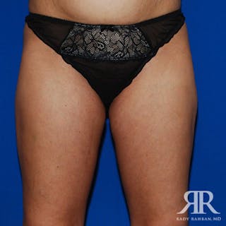 Liposuction Before & After Gallery - Patient 302512 - Image 2