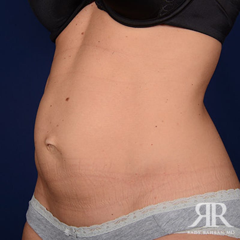 Tummy Tuck Before & After Gallery - Patient 125258 - Image 3