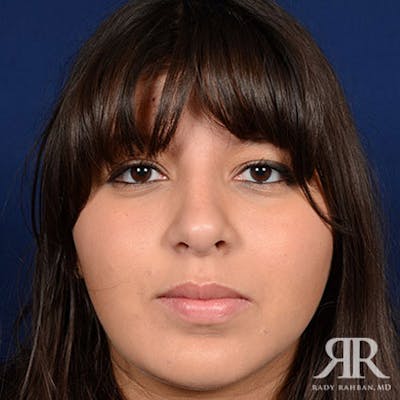 Female Rhinoplasty Before & After Gallery - Patient 178011 - Image 2