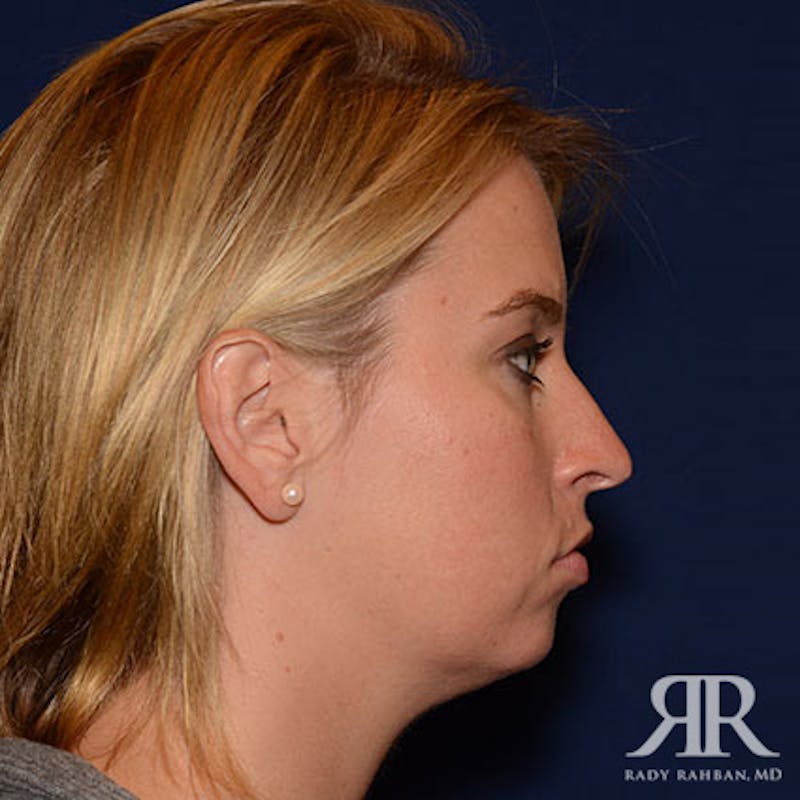 Chin Augmentation Before & After Gallery - Patient 310780 - Image 5