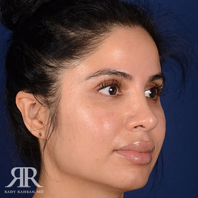 Corrective / Revision Rhinoplasty Before & After Gallery - Patient 714159 - Image 4
