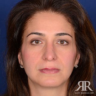 Rhinoplasty w/ Chin Implant Before & After Gallery - Patient 144476 - Image 2