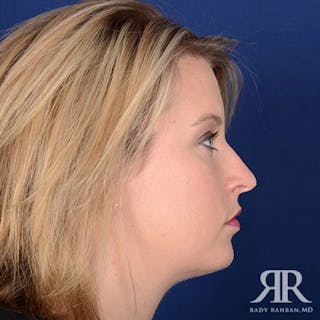 Chin Augmentation Before & After Gallery - Patient 310780 - Image 6
