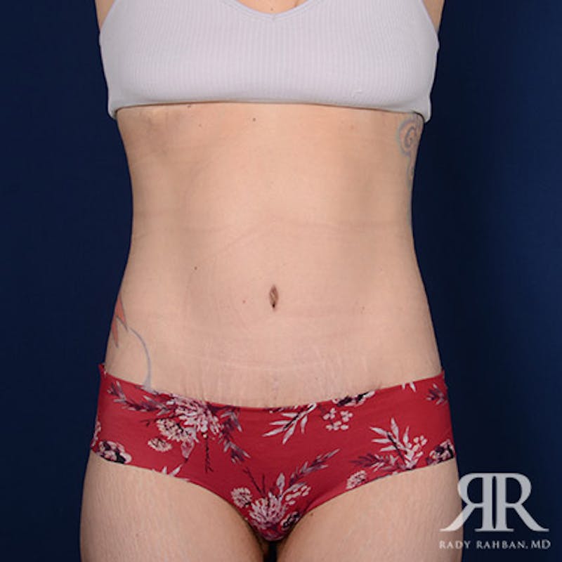 Body Lift Before & After Gallery - Patient 336362 - Image 2