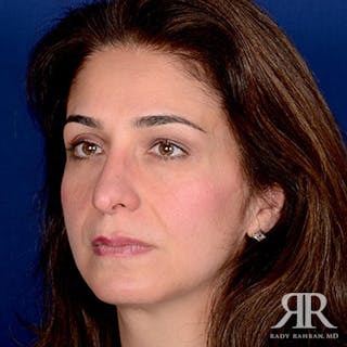 Rhinoplasty w/ Chin Implant Before & After Gallery - Patient 144476 - Image 4