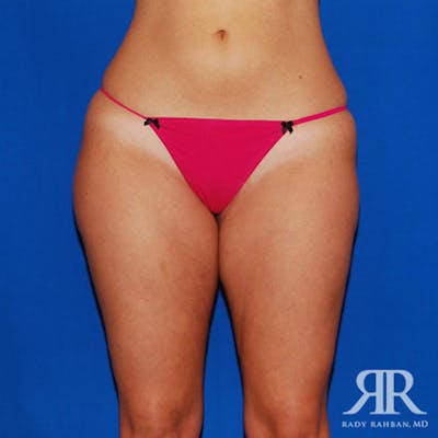 Liposuction Before & After Gallery - Patient 271551 - Image 1