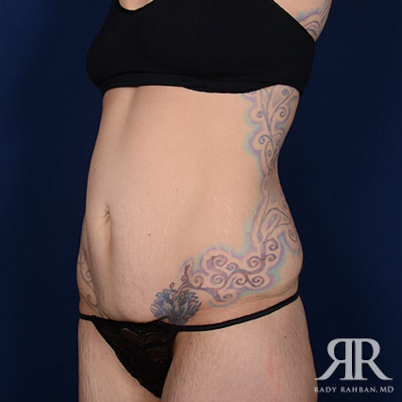 Body Lift Before & After Gallery - Patient 336362 - Image 3