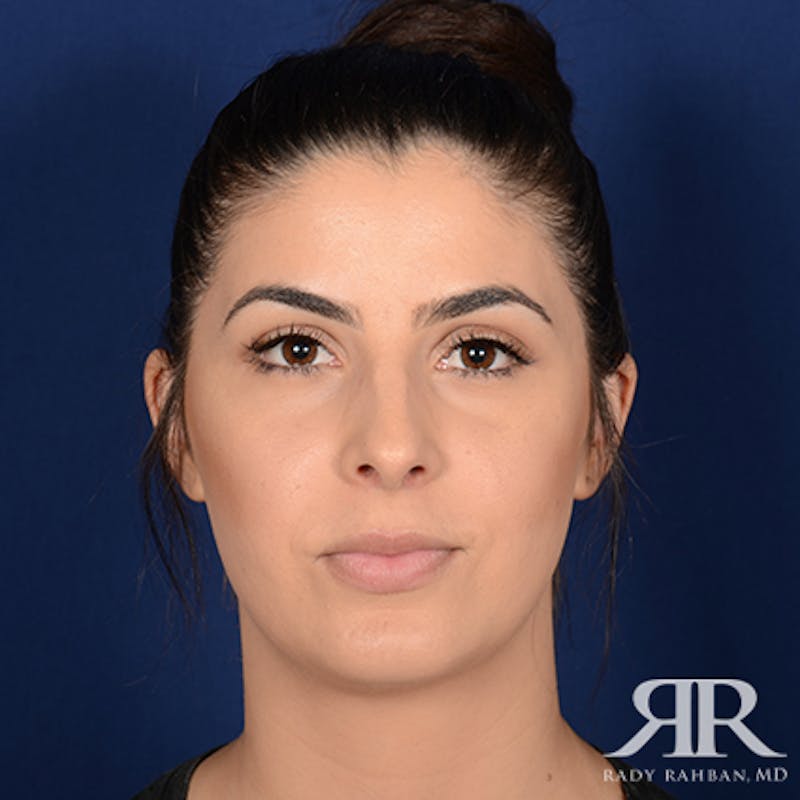 Chin Augmentation Before & After Gallery - Patient 325616 - Image 2
