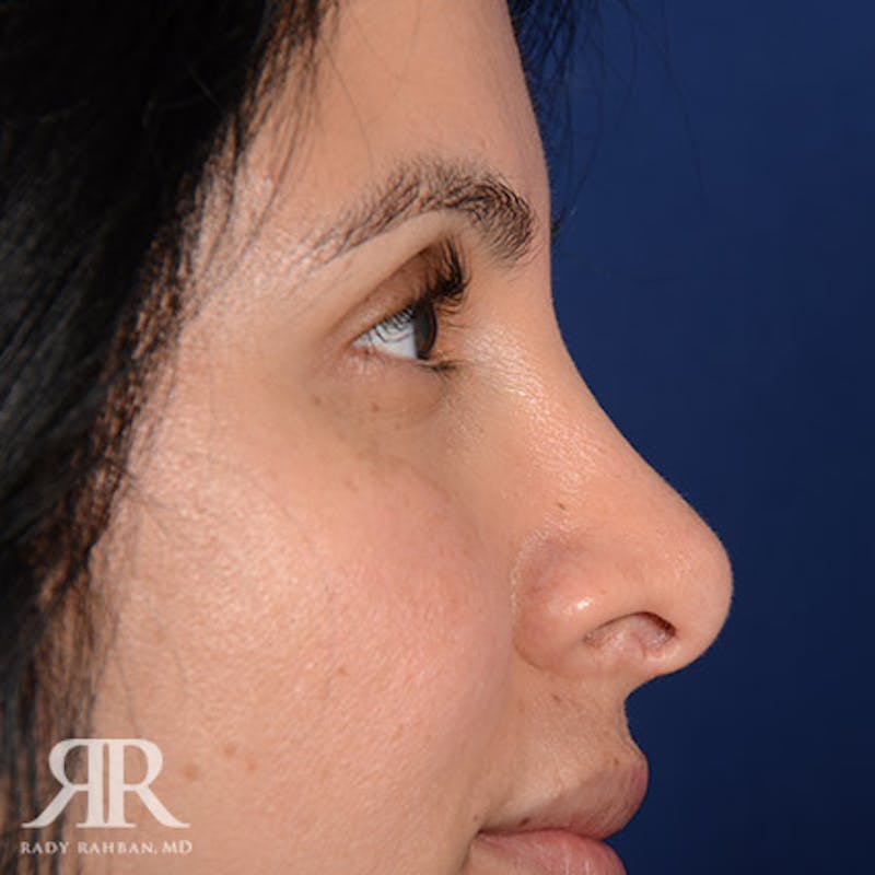 Corrective / Revision Rhinoplasty Before & After Gallery - Patient 714159 - Image 7
