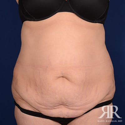 Tummy Tuck Before & After Gallery - Patient 133394 - Image 1