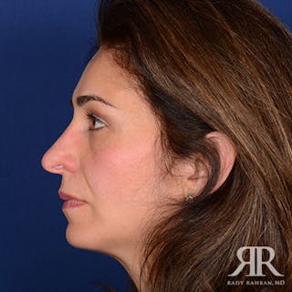 Rhinoplasty w/ Chin Implant Before & After Gallery - Patient 144476 - Image 6