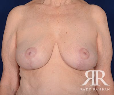 Breast Reduction Before & After Gallery - Patient 180263 - Image 2