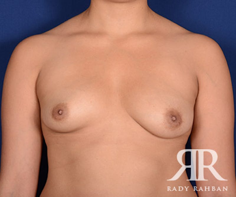 Breast Lift Before & After Gallery - Patient 546131 - Image 1