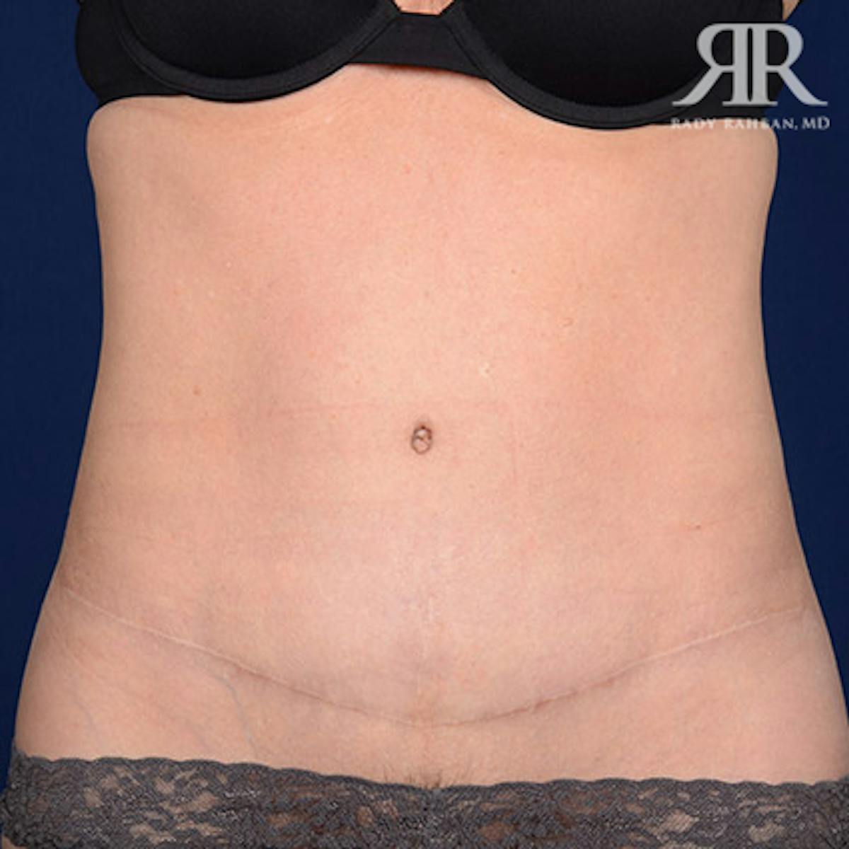 Tummy Tuck Scars Before & After Gallery - Patient 303285 - Image 1