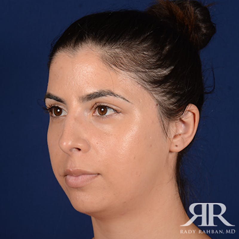 Chin Augmentation Before & After Gallery - Patient 325616 - Image 3