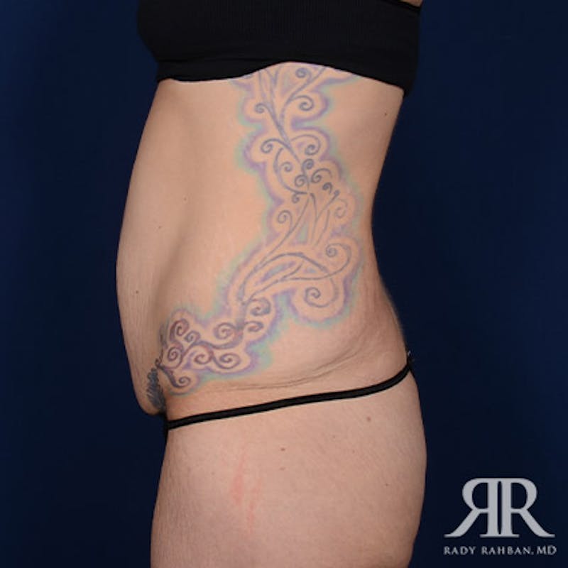 Body Lift Before & After Gallery - Patient 336362 - Image 5