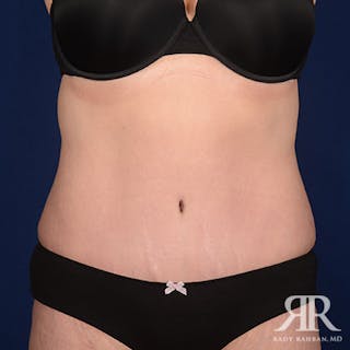 Tummy Tuck Before & After Gallery - Patient 133394 - Image 2