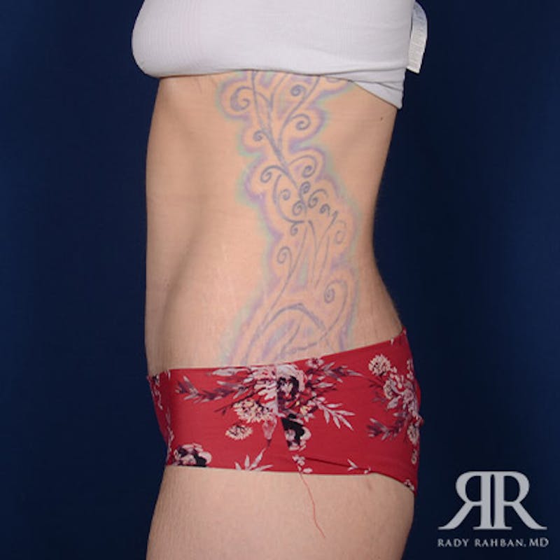 Body Lift Before & After Gallery - Patient 336362 - Image 6