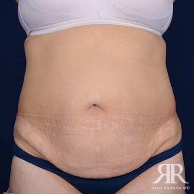 Severe Diastasis Recti Before & After Gallery - Patient 414277 - Image 1