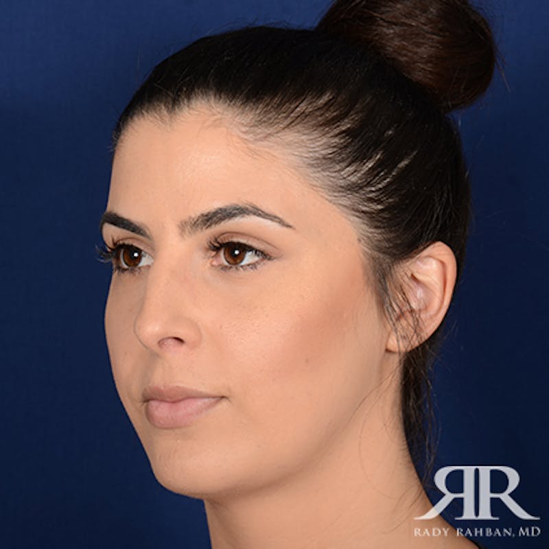 Chin Augmentation Before & After Gallery - Patient 325616 - Image 4
