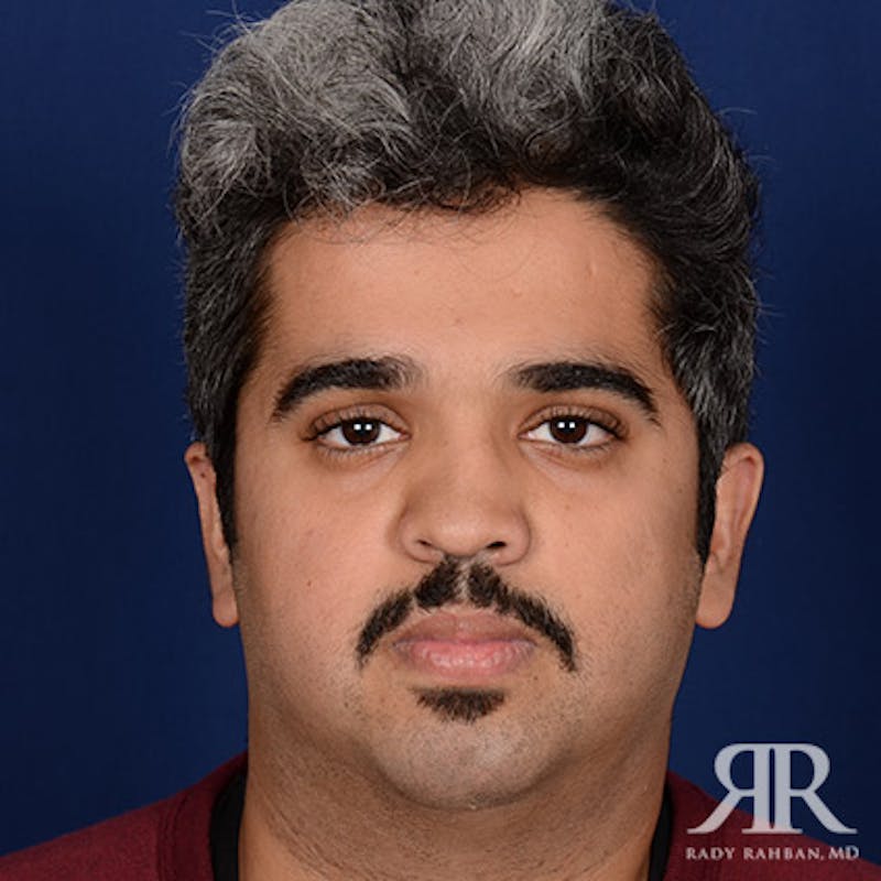 Rhinoplasty w/ Chin Implant Before & After Gallery - Patient 156274 - Image 1
