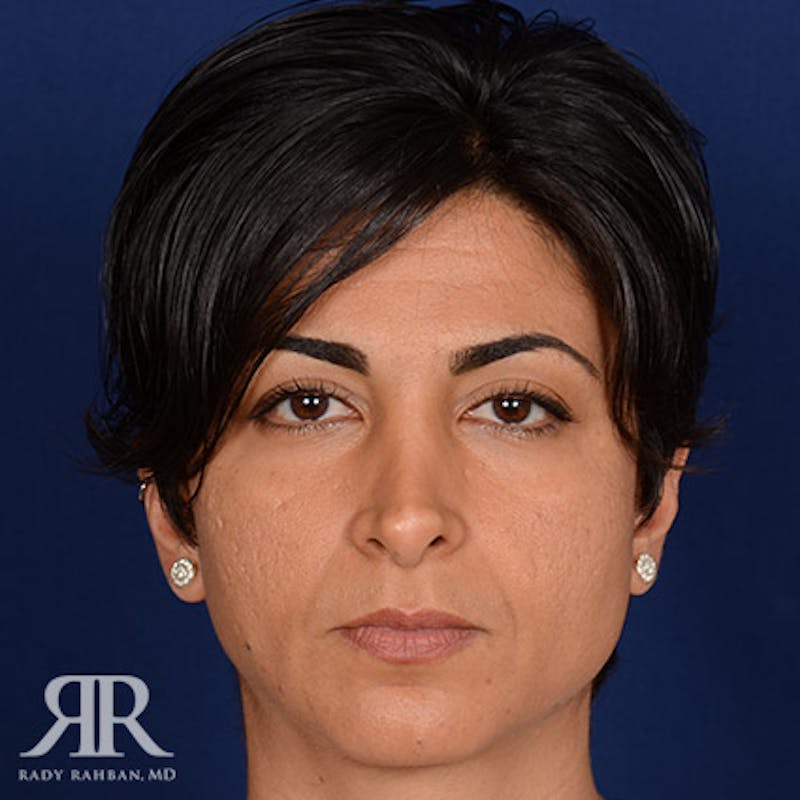Corrective / Revision Rhinoplasty Before & After Gallery - Patient 204579 - Image 1