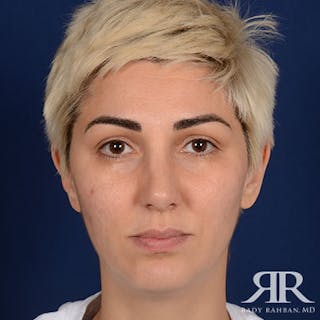 Female Rhinoplasty Before & After Gallery - Patient 246651 - Image 2