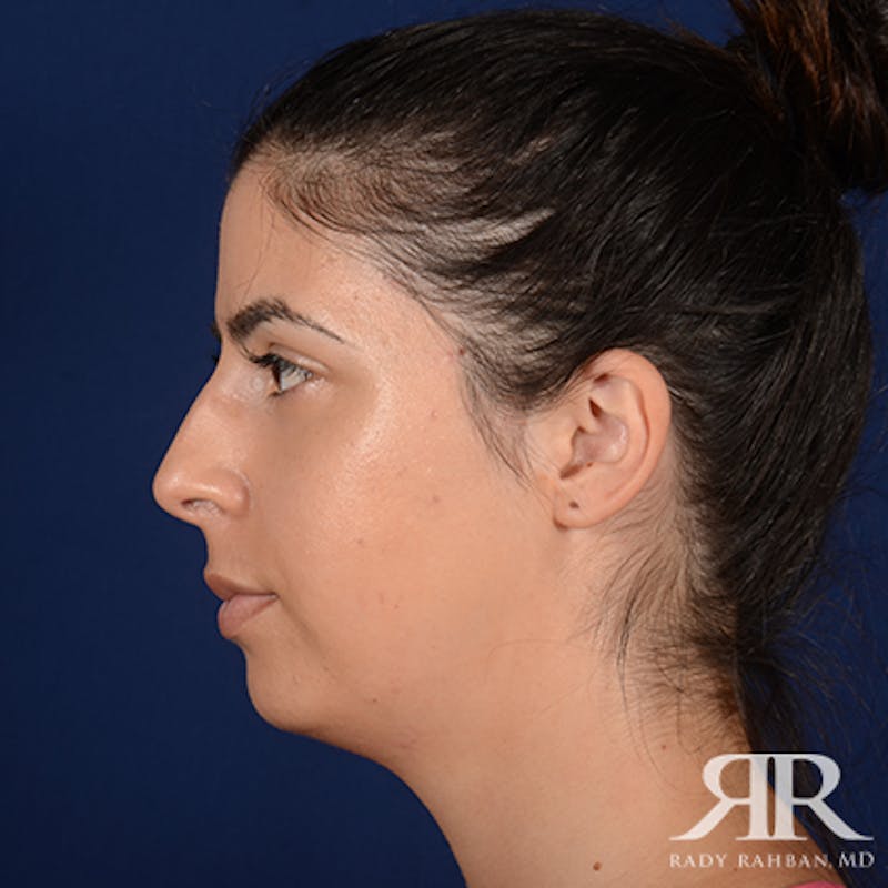 Chin Augmentation Before & After Gallery - Patient 325616 - Image 5