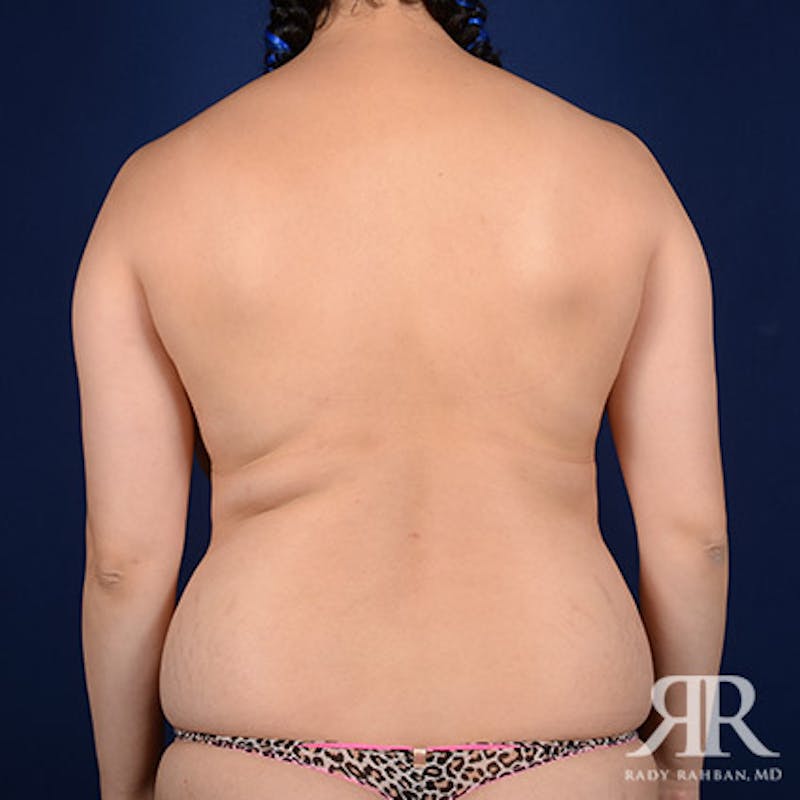 Mommy Makeover Before & After Gallery - Patient 389932 - Image 7