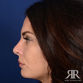 Ethnic Rhinoplasty Before & After Gallery - Patient 355384 - Image 6