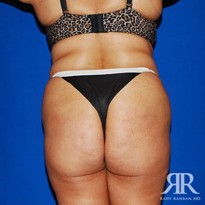 Liposuction Before & After Gallery - Patient 213870 - Image 1