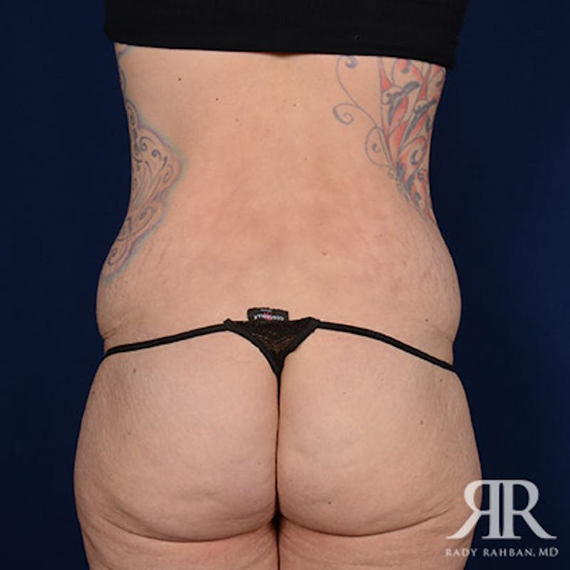 Body Lift Before & After Gallery - Patient 336362 - Image 7