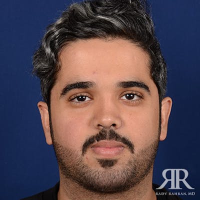 Rhinoplasty w/ Chin Implant Before & After Gallery - Patient 156274 - Image 2