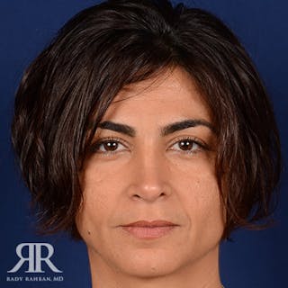 Corrective / Revision Rhinoplasty Before & After Gallery - Patient 204579 - Image 2