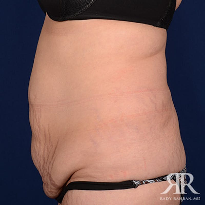 Tummy Tuck Before & After Gallery - Patient 133394 - Image 5