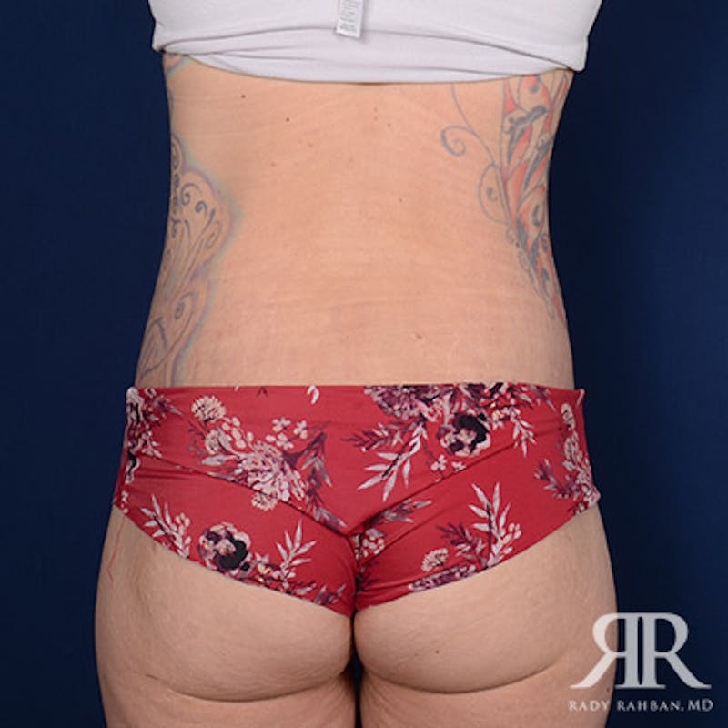 Body Lift Before & After Gallery - Patient 336362 - Image 8