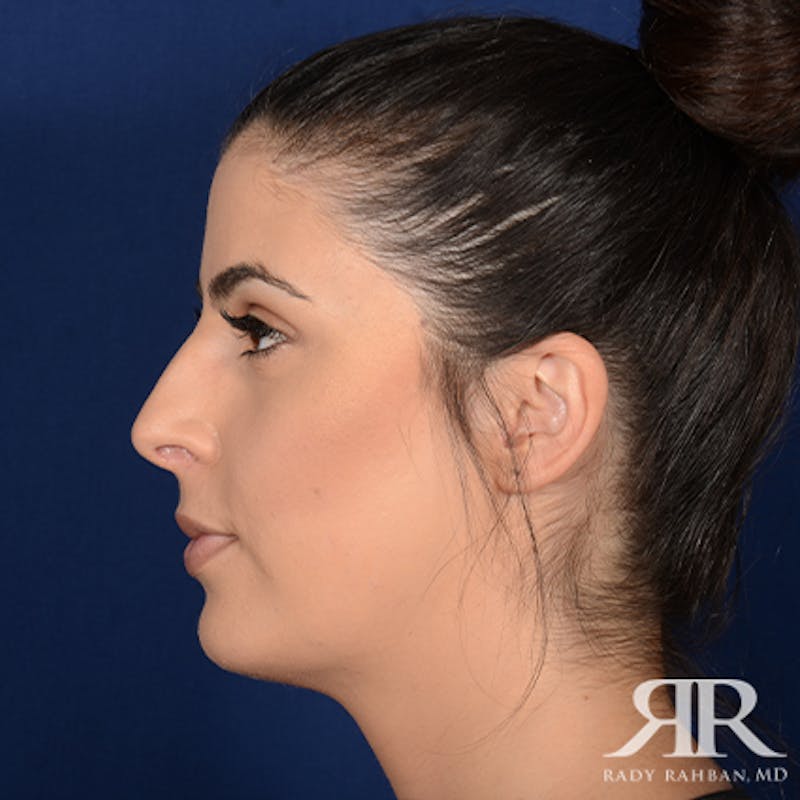 Chin Augmentation Before & After Gallery - Patient 325616 - Image 6