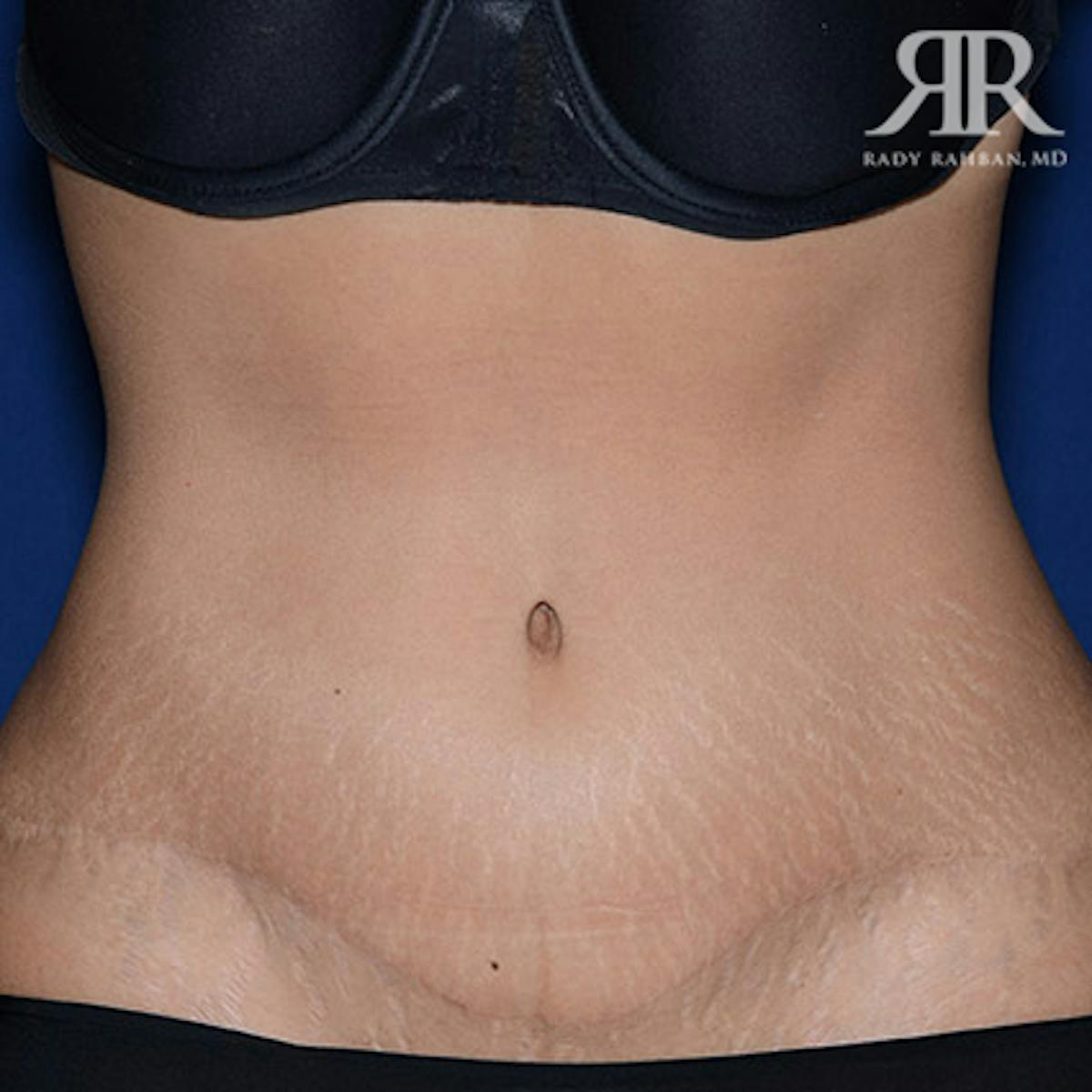 Tummy Tuck Scars Before & After Gallery - Patient 335736 - Image 1