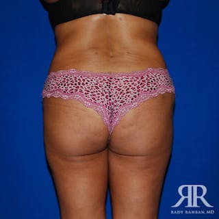 Liposuction Before & After Gallery - Patient 213870 - Image 2
