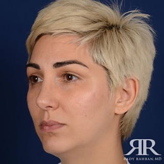 Female Rhinoplasty Before & After Gallery - Patient 246651 - Image 4