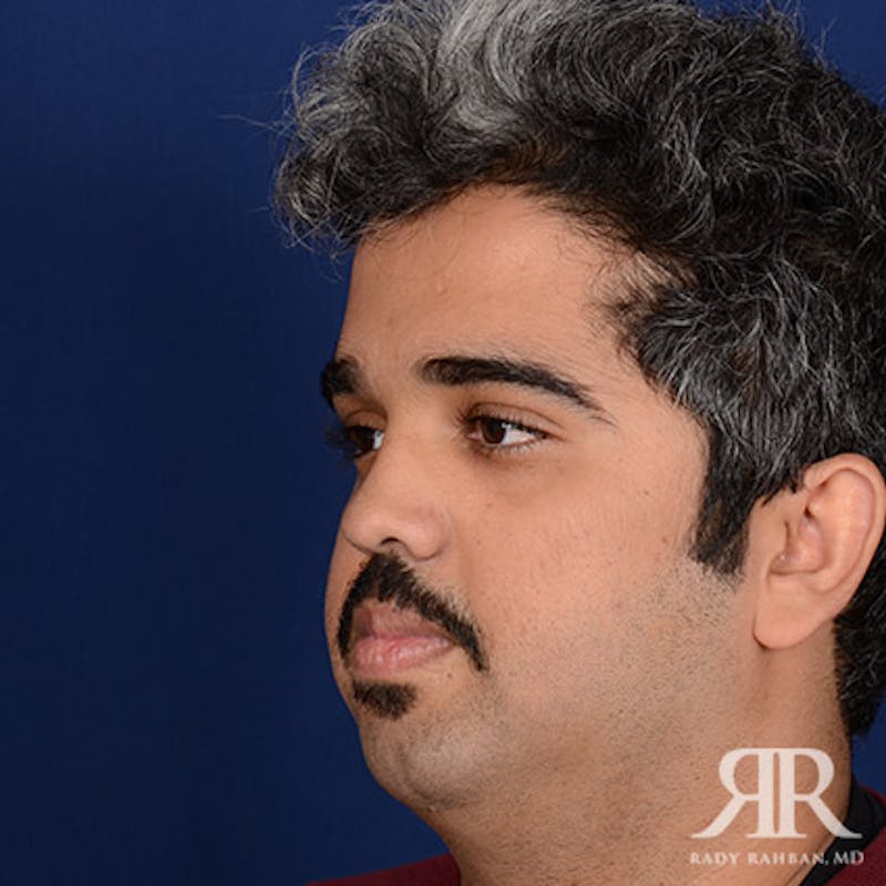 Rhinoplasty w/ Chin Implant Before & After Gallery - Patient 156274 - Image 3