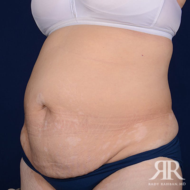 Severe Diastasis Recti Before & After Gallery - Patient 414277 - Image 3